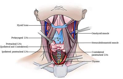 Pretracheal Lymph Node Subdivision in Predicting Contralateral Central Lymph Node Metastasis for Unilateral Papillary Thyroid Carcinoma: Preliminary Results